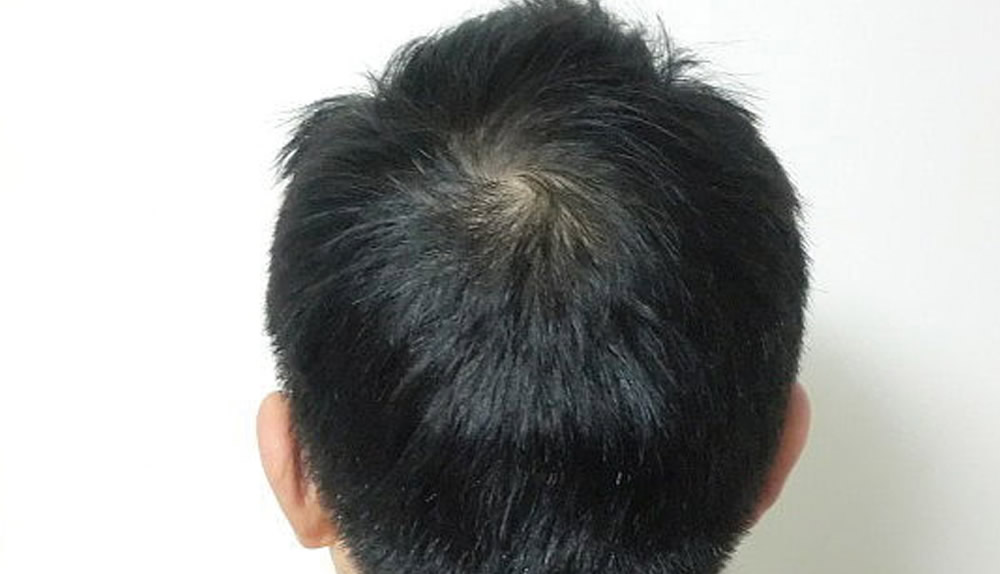 私が自毛植毛にたどり着いた理由